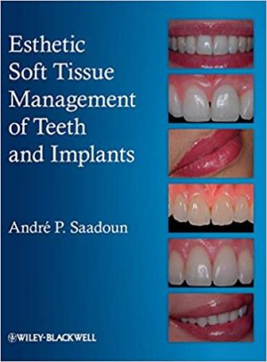 Esthetic Soft Tissue Management Of Teeth And Implants