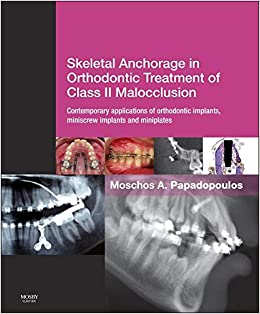 Skeletal Anchorage in Orthodontic Treatment of Class II Malocclusion Contemporary Applications Of Orthodontic implants Miniscrew implants And Mini Plates